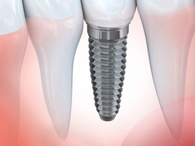 Implantes dentales Antequera